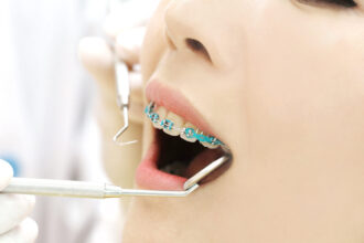 部分歯科矯正を受ける女性