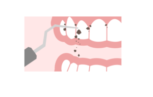 歯石の除去