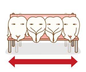 歯の重なりを改善するための装置