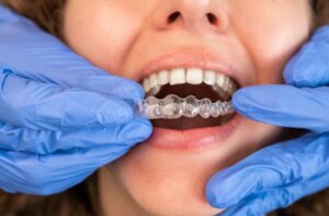 女性患者の歯に目に見えないアライナーを適用する手袋の歯科医