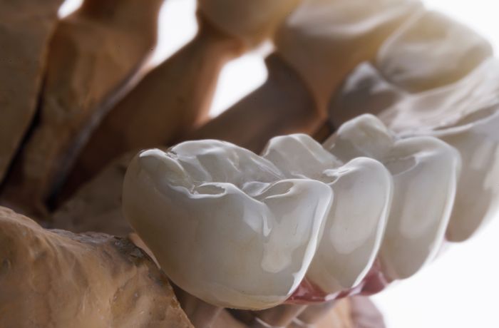 セラミックの被せ物