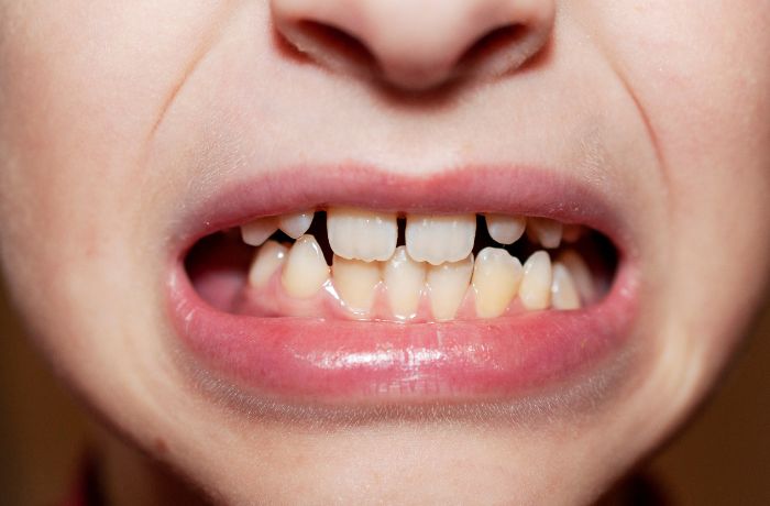 歯並びの悪い子供