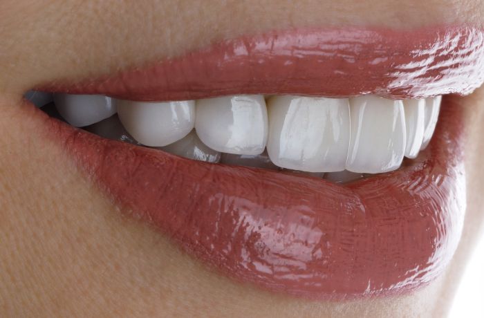 セラミックで治療した女性の歯
